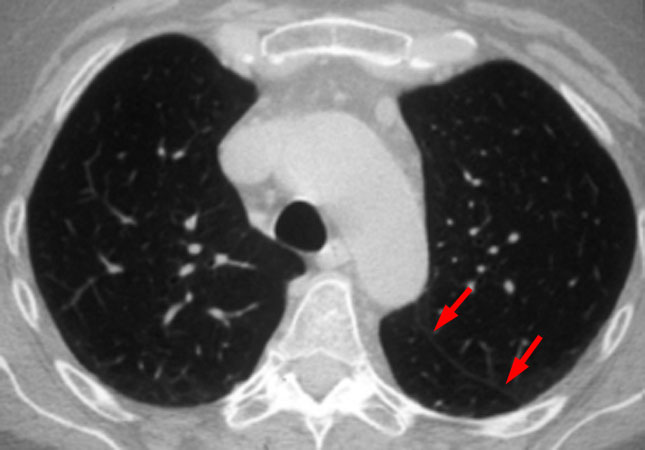 Chest Radiology 